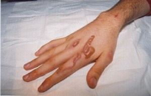 hand_burnt_by_LN2